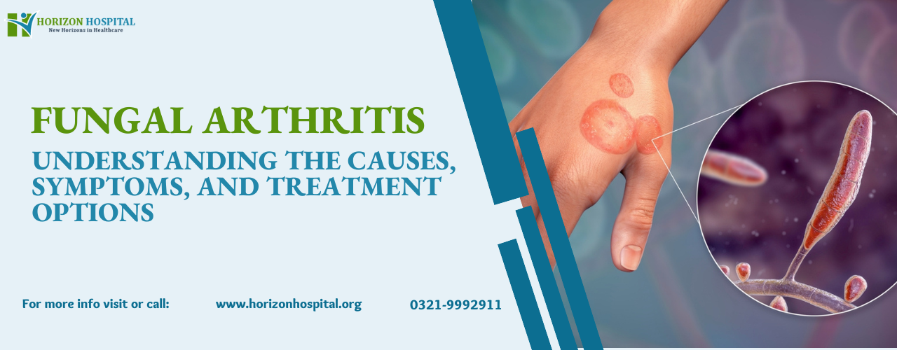 Fungal Arthritis: Causes, Symptoms, and Treatment