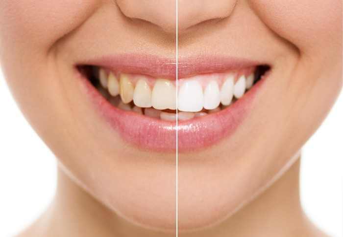 Teeth-Whitening