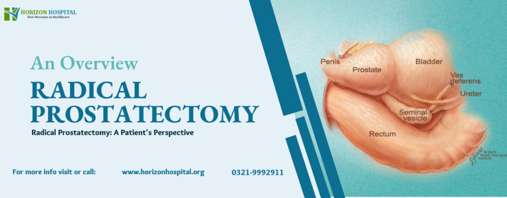 Radical Prostatectomy: A Patient’s Perspective